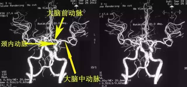 手把手教会阅读颅脑MRA和CTA 手把手教会阅读颅脑MRA和CTA