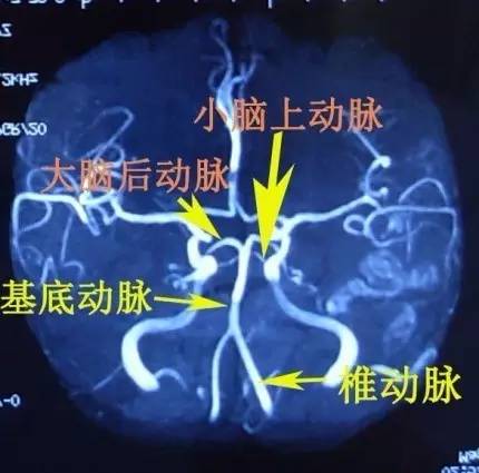 手把手教会阅读颅脑MRA和CTA 手把手教会阅读颅脑MRA和CTA