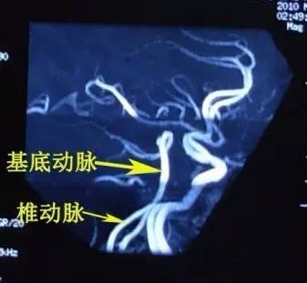手把手教会阅读颅脑MRA和CTA 手把手教会阅读颅脑MRA和CTA