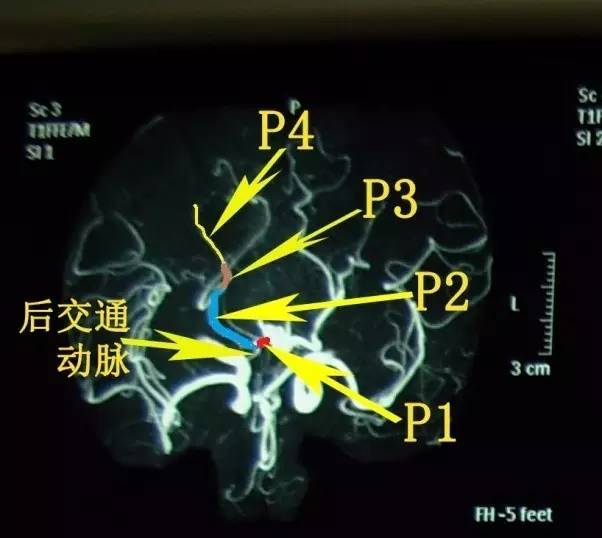 手把手教会阅读颅脑MRA和CTA 手把手教会阅读颅脑MRA和CTA