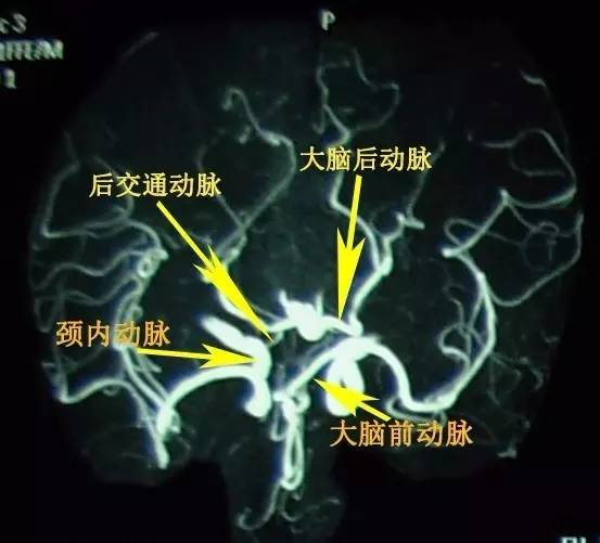 手把手教会阅读颅脑MRA和CTA 手把手教会阅读颅脑MRA和CTA