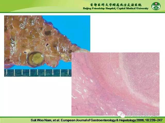 【PPT】肝脏影像报告与数据系统2014