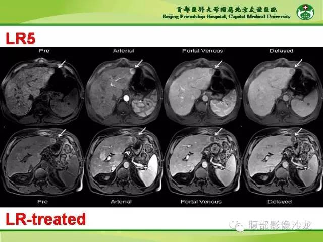 【PPT】肝脏影像报告与数据系统2014