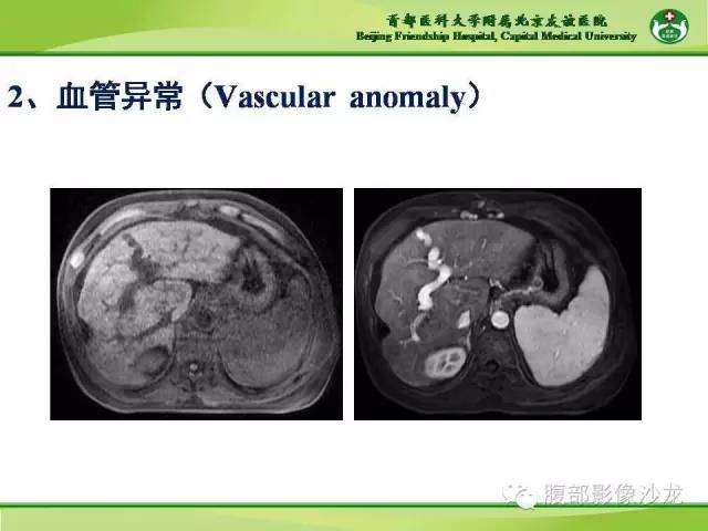 【PPT】肝脏影像报告与数据系统2014