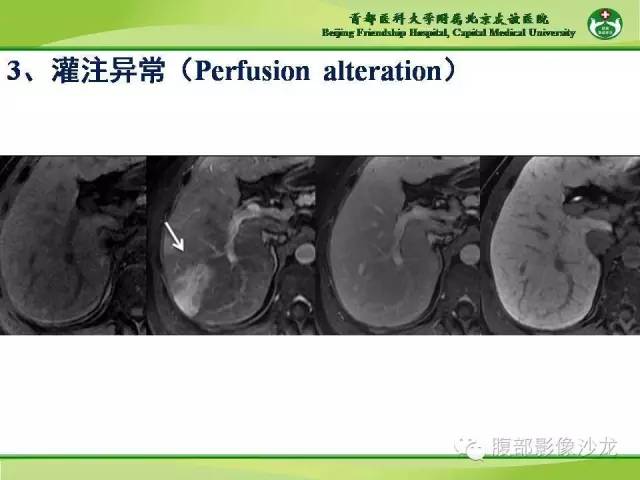 【PPT】肝脏影像报告与数据系统2014