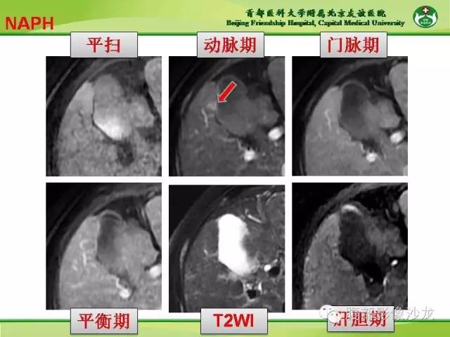 【PPT】肝脏影像报告与数据系统2014
