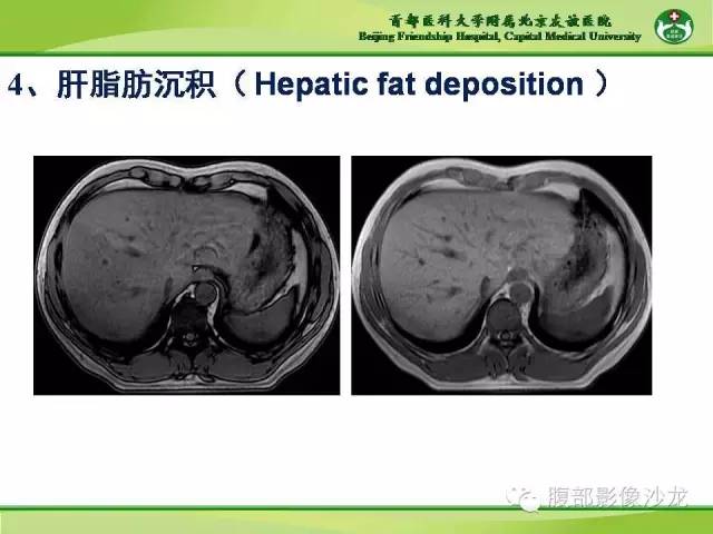 【PPT】肝脏影像报告与数据系统2014