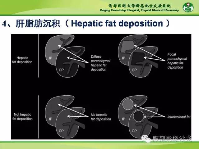 【PPT】肝脏影像报告与数据系统2014