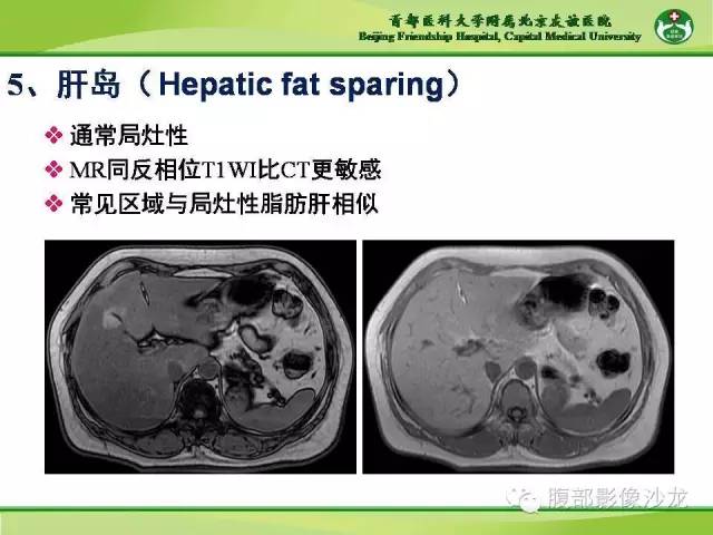 【PPT】肝脏影像报告与数据系统2014