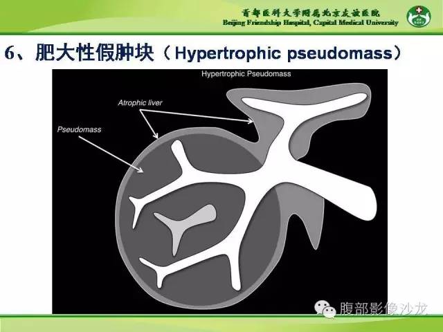 【PPT】肝脏影像报告与数据系统2014