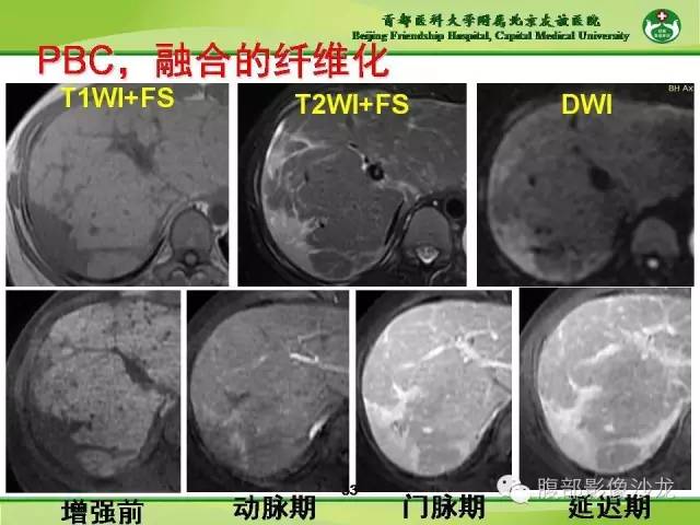 【PPT】肝脏影像报告与数据系统2014