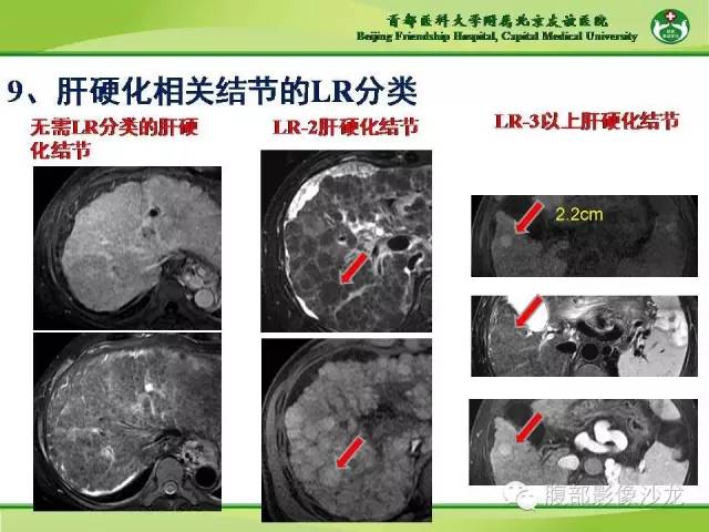 【PPT】肝脏影像报告与数据系统2014