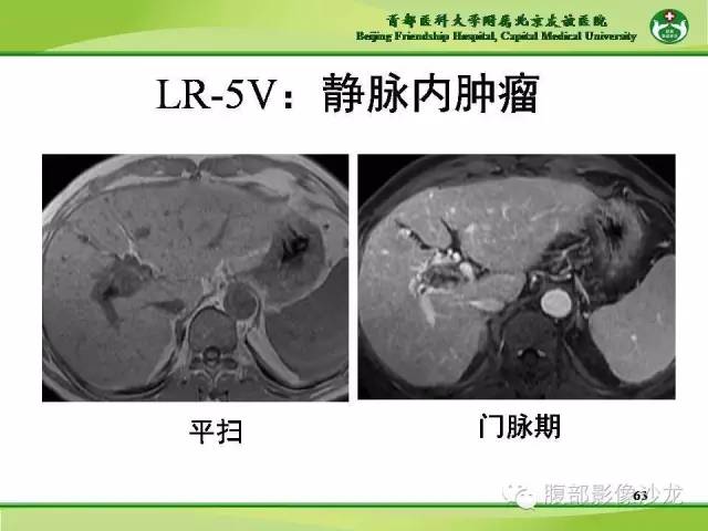 【PPT】肝脏影像报告与数据系统2014