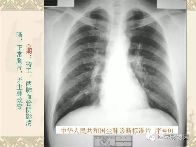 【PPT】尘肺病诊断标准&标准片阅片解读