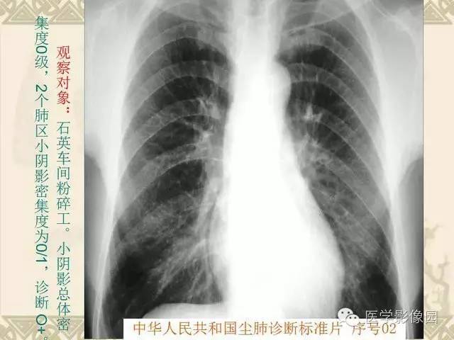 【PPT】尘肺病诊断标准&标准片阅片解读