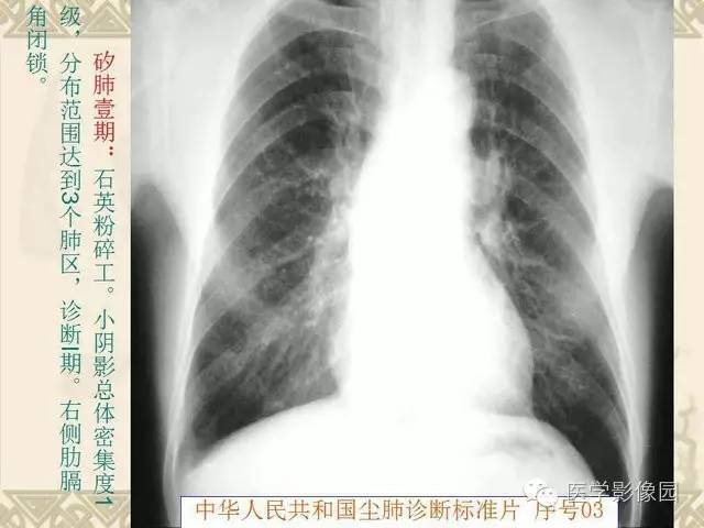 【PPT】尘肺病诊断标准&标准片阅片解读