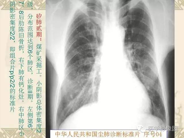 【PPT】尘肺病诊断标准&标准片阅片解读
