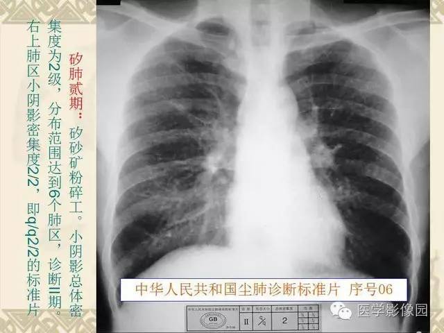 【PPT】尘肺病诊断标准&标准片阅片解读