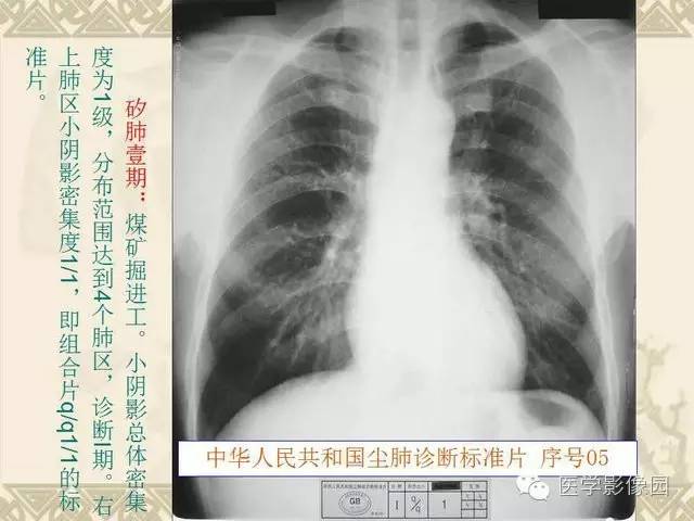 【PPT】尘肺病诊断标准&标准片阅片解读