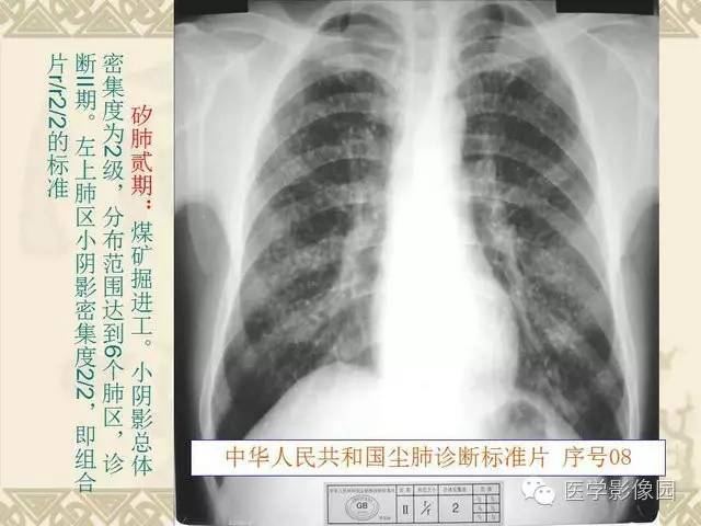 【PPT】尘肺病诊断标准&标准片阅片解读