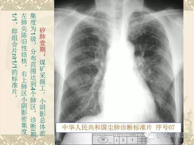【PPT】尘肺病诊断标准&标准片阅片解读