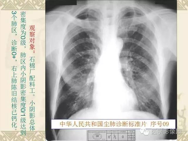 【PPT】尘肺病诊断标准&标准片阅片解读