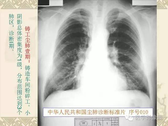 【PPT】尘肺病诊断标准&标准片阅片解读