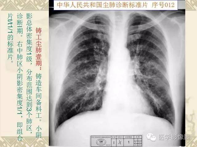 【PPT】尘肺病诊断标准&标准片阅片解读