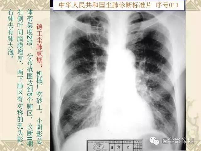 【PPT】尘肺病诊断标准&标准片阅片解读