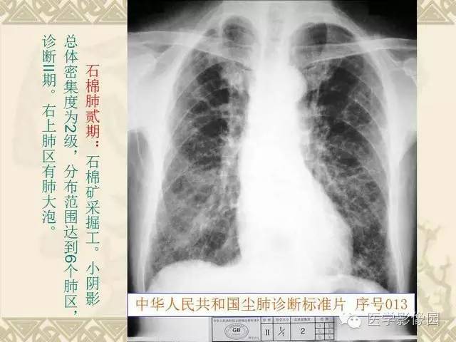 【PPT】尘肺病诊断标准&标准片阅片解读