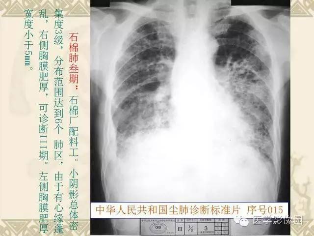 【PPT】尘肺病诊断标准&标准片阅片解读