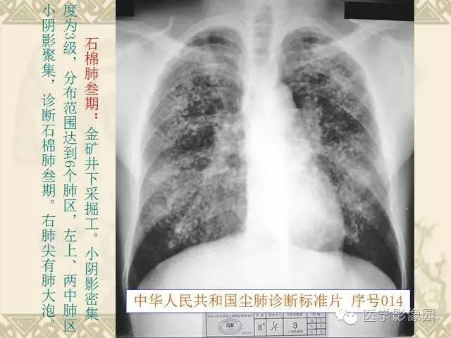【PPT】尘肺病诊断标准&标准片阅片解读