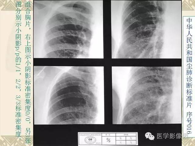 【PPT】尘肺病诊断标准&标准片阅片解读