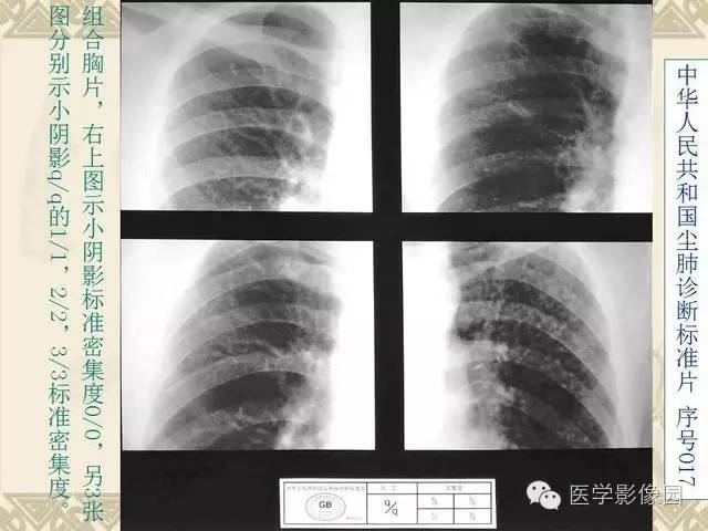 【PPT】尘肺病诊断标准&标准片阅片解读