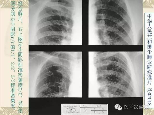 【PPT】尘肺病诊断标准&标准片阅片解读