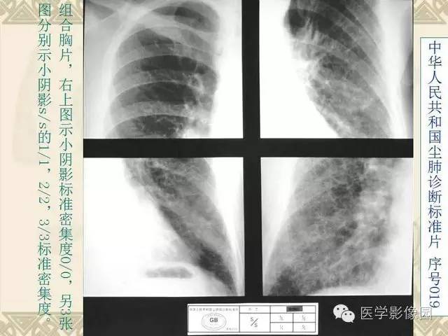 【PPT】尘肺病诊断标准&标准片阅片解读