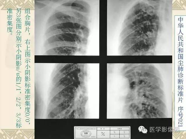 【PPT】尘肺病诊断标准&标准片阅片解读