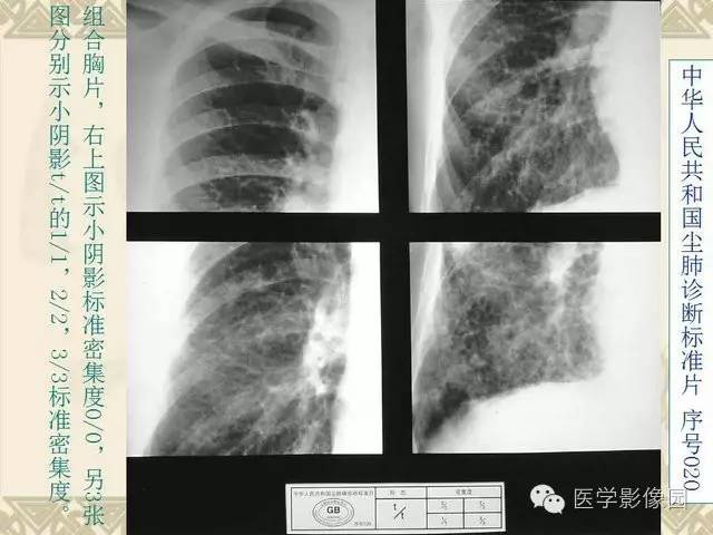【PPT】尘肺病诊断标准&标准片阅片解读