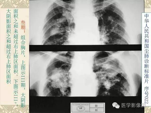 【PPT】尘肺病诊断标准&标准片阅片解读
