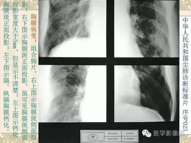 【PPT】尘肺病诊断标准&标准片阅片解读