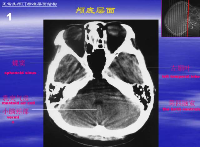 【PPT】中枢神经系统正常影像学表现