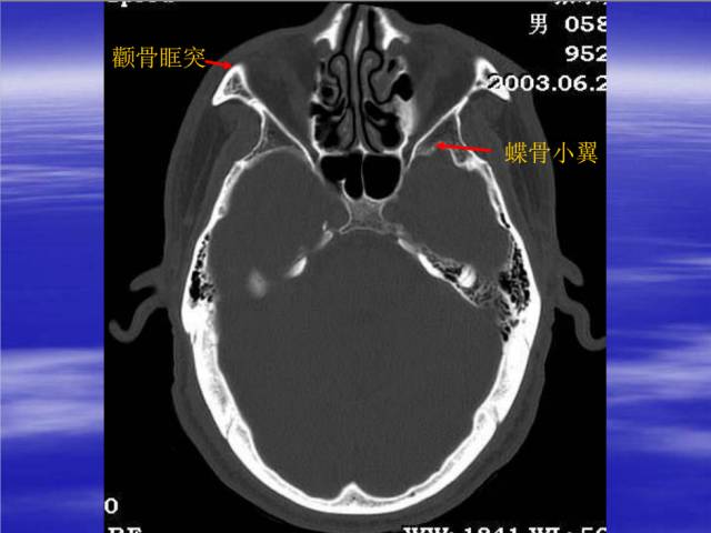 【PPT】中枢神经系统正常影像学表现