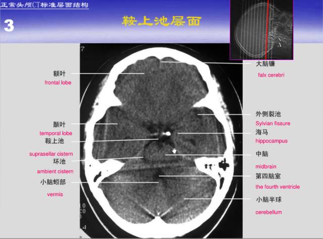 【PPT】中枢神经系统正常影像学表现