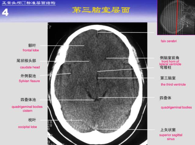 【PPT】中枢神经系统正常影像学表现