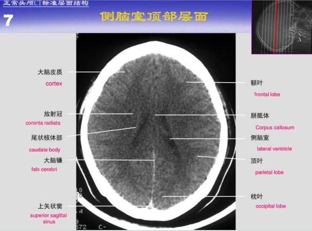 【PPT】中枢神经系统正常影像学表现