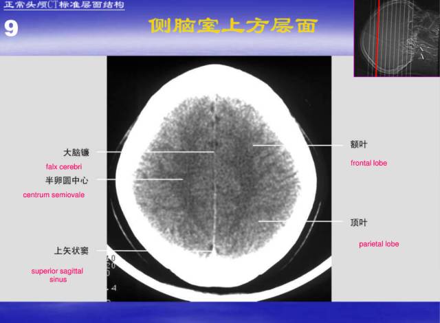 【PPT】中枢神经系统正常影像学表现