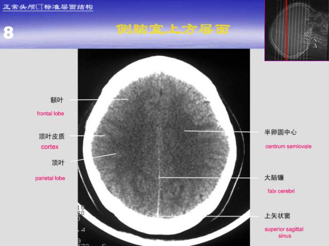 【PPT】中枢神经系统正常影像学表现