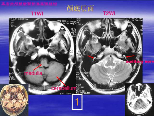 【PPT】中枢神经系统正常影像学表现