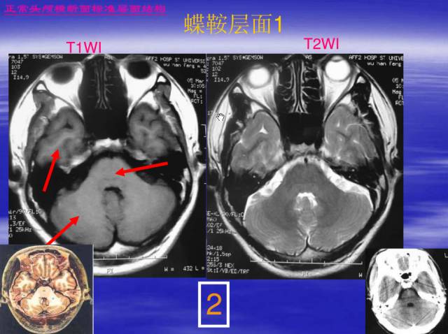 【PPT】中枢神经系统正常影像学表现