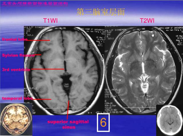 【PPT】中枢神经系统正常影像学表现